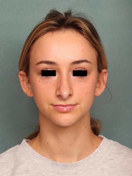 Rhinoplasty Before & After Patient #9205