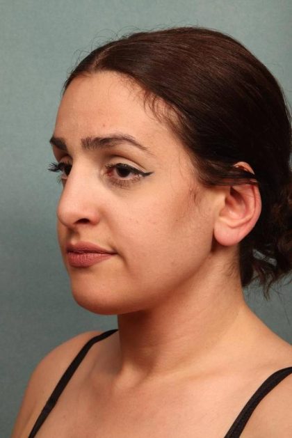 Rhinoplasty Before & After Patient #9206
