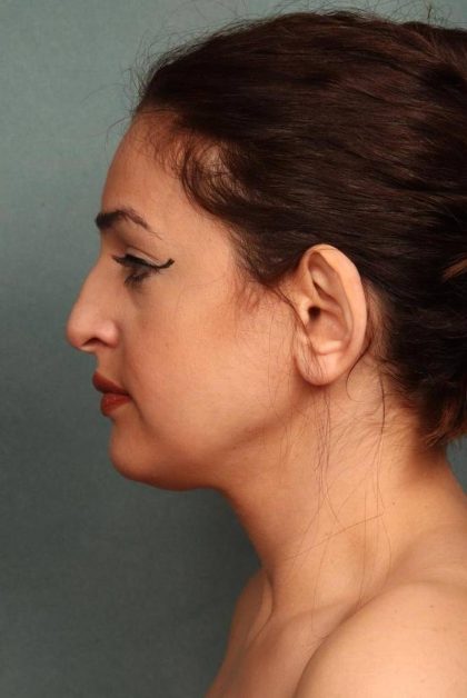 Rhinoplasty Before & After Patient #9206