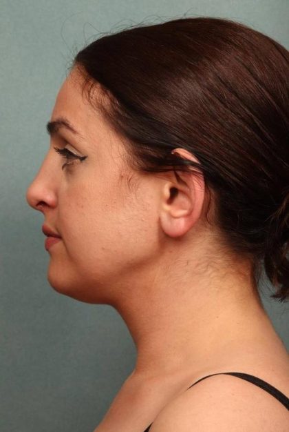 Rhinoplasty Before & After Patient #9206