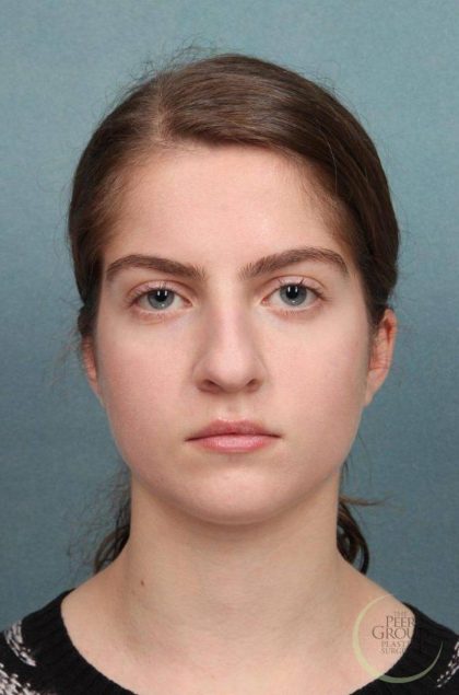 Rhinoplasty Before & After Patient #9207