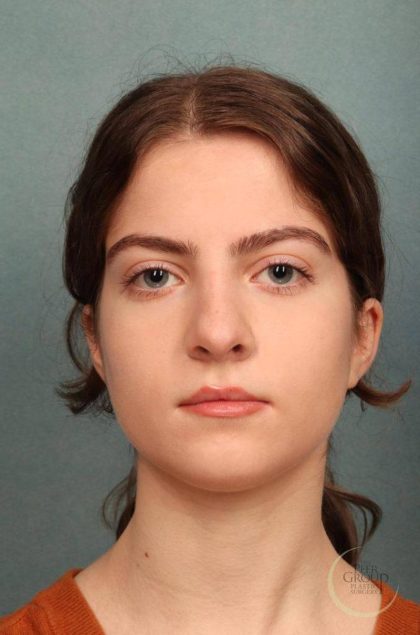 Rhinoplasty Before & After Patient #9207