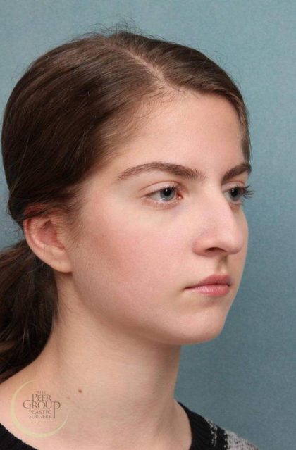 Rhinoplasty Before & After Patient #9207