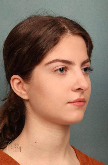 Rhinoplasty Before & After Patient #9207