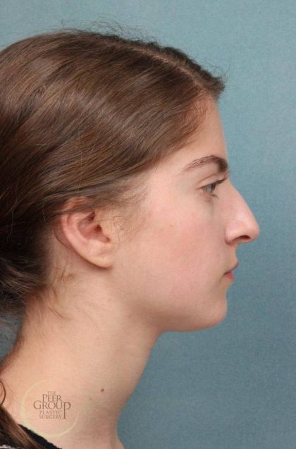 Rhinoplasty Before & After Patient #9207