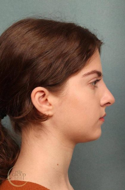 Rhinoplasty Before & After Patient #9207