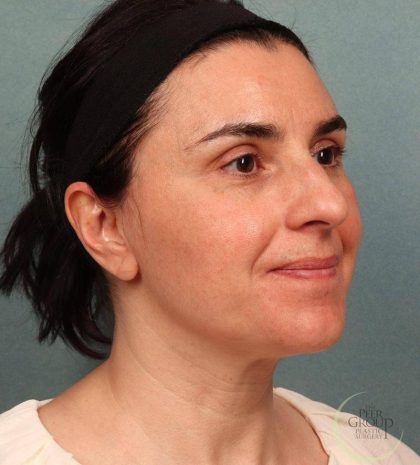 Rhinoplasty Before & After Patient #9208