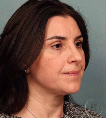 Rhinoplasty Before & After Patient #9208