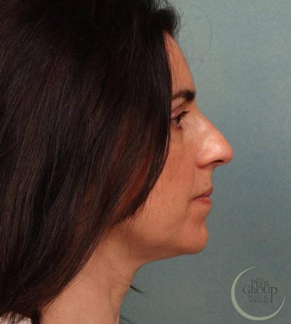 Rhinoplasty Before & After Patient #9208