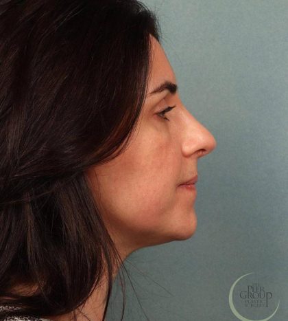 Rhinoplasty Before & After Patient #9208