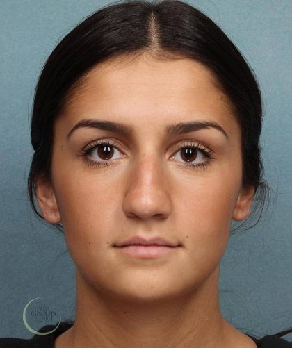 Rhinoplasty Before & After Patient #9209