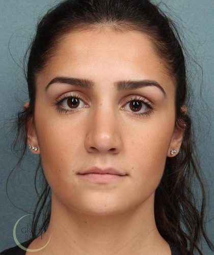 Rhinoplasty Before & After Patient #9209