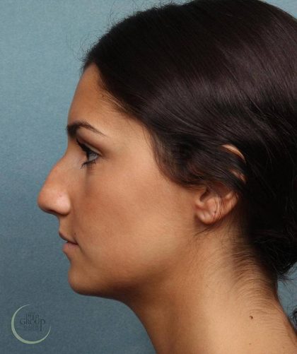Rhinoplasty Before & After Patient #9209