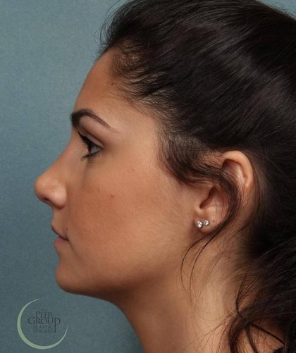 Rhinoplasty Before & After Patient #9209