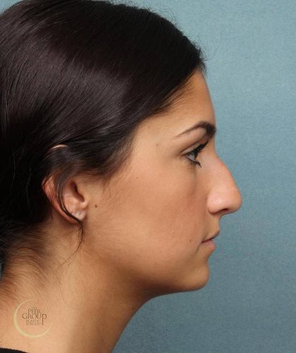 Rhinoplasty Before & After Patient #9209