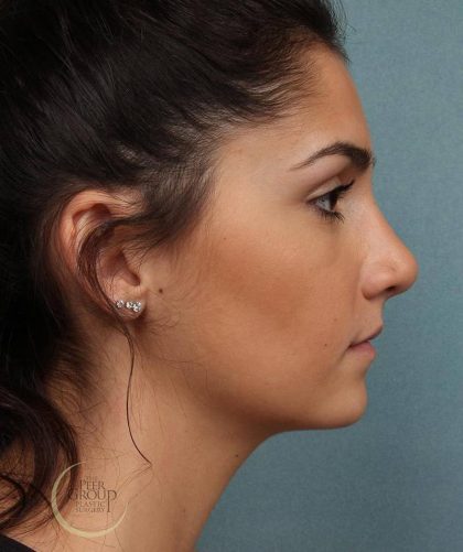 Rhinoplasty Before & After Patient #9209