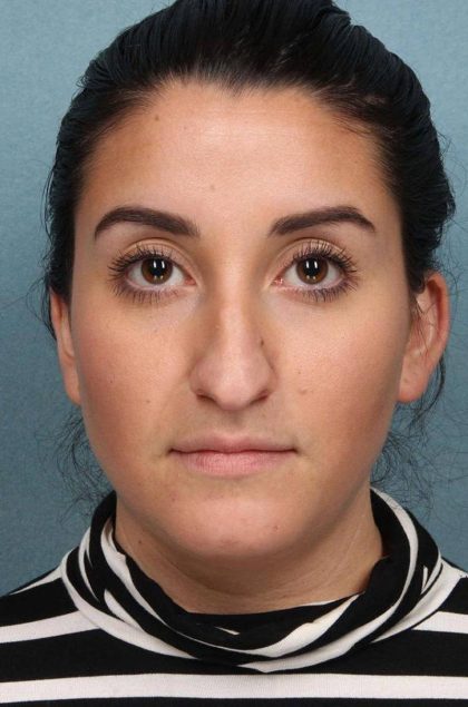 Rhinoplasty Before & After Patient #9213