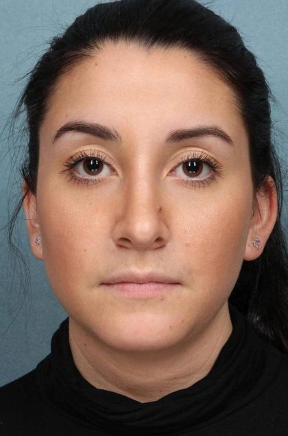 Rhinoplasty Before & After Patient #9213