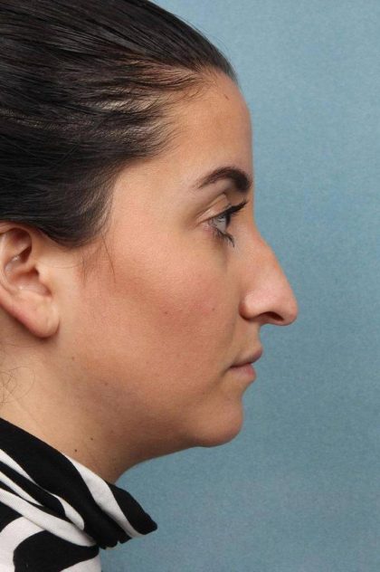 Rhinoplasty Before & After Patient #9213