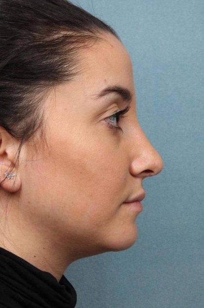 Rhinoplasty Before & After Patient #9213