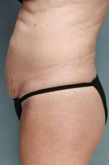 Sculpsure Before & After Patient #9105
