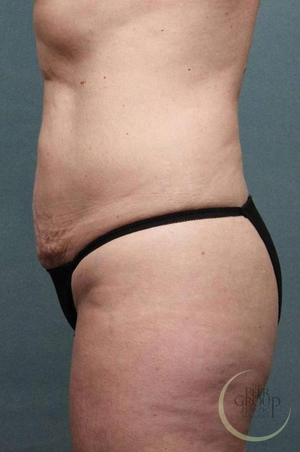 Sculpsure Before & After Patient #9105