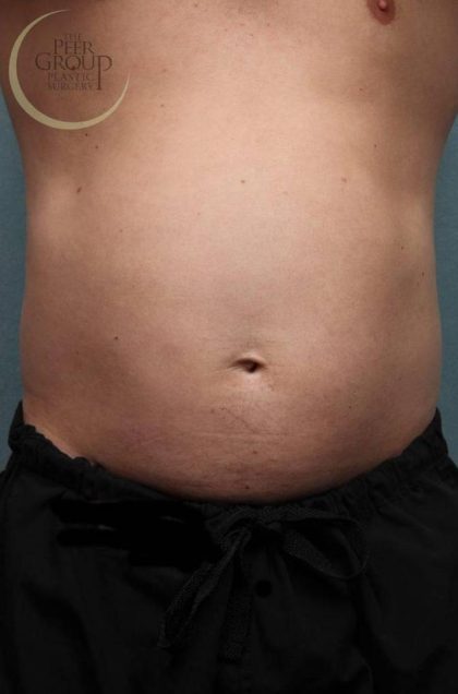 Sculpsure Before & After Patient #9106