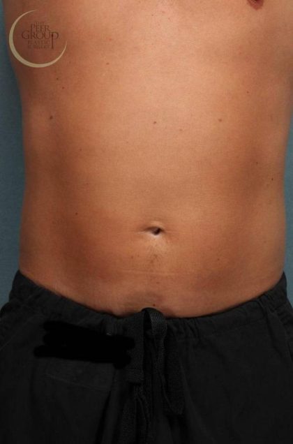 Sculpsure Before & After Patient #9106