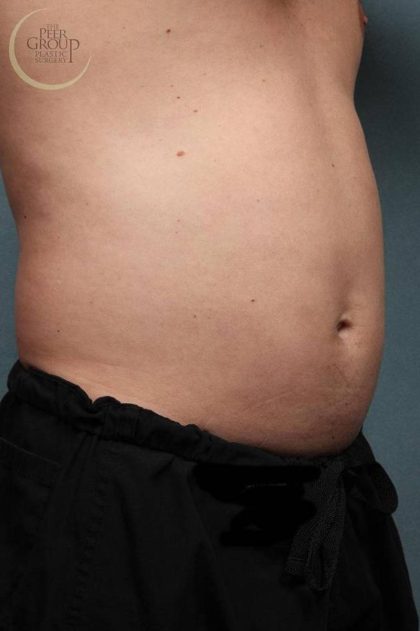 Sculpsure Before & After Patient #9106