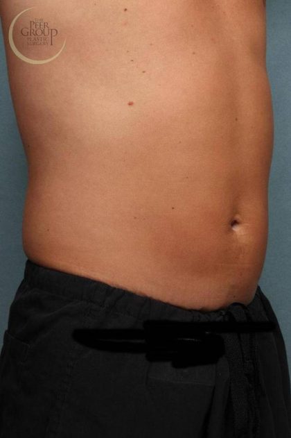 Sculpsure Before & After Patient #9106