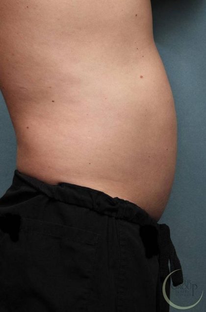 Sculpsure Before & After Patient #9106