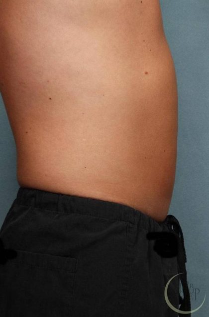 Sculpsure Before & After Patient #9106