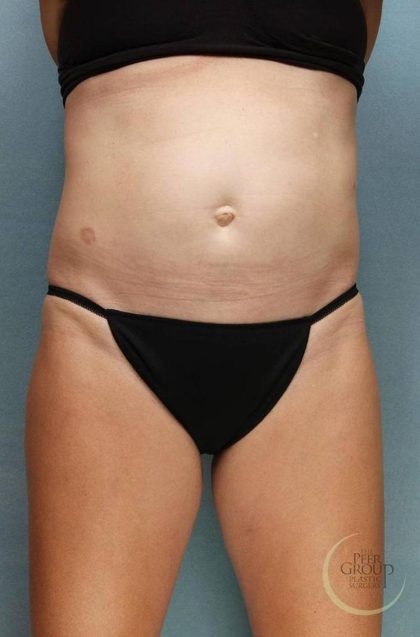 Sculpsure Before & After Patient #9107