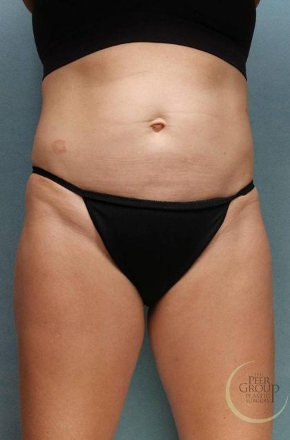 Sculpsure Before & After Patient #9107