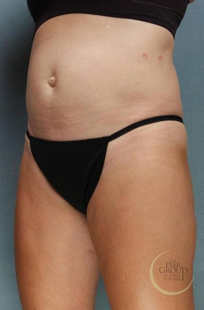Sculpsure Before & After Patient #9107