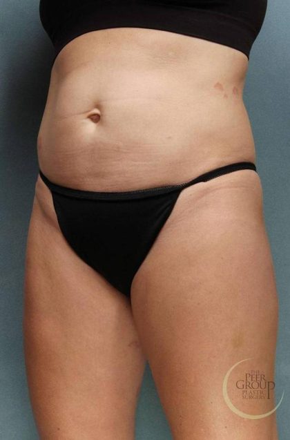 Sculpsure Before & After Patient #9107