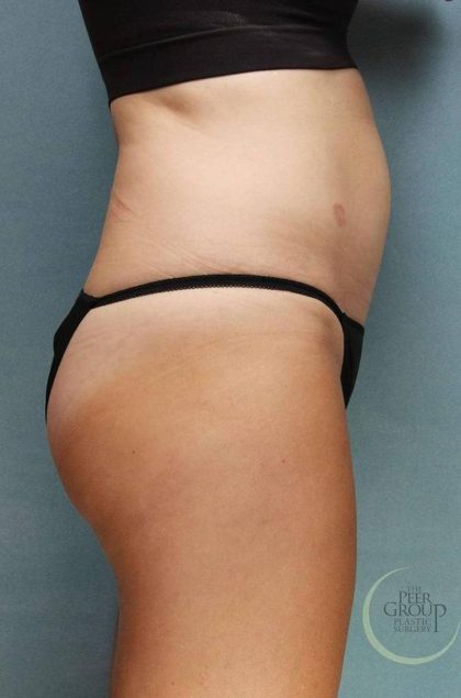 Sculpsure Before & After Patient #9107