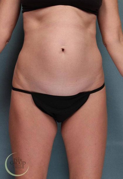 Tummy Tuck Before & After Patient #9144