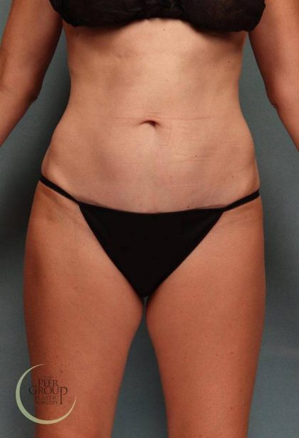 Tummy Tuck Before & After Patient #9144