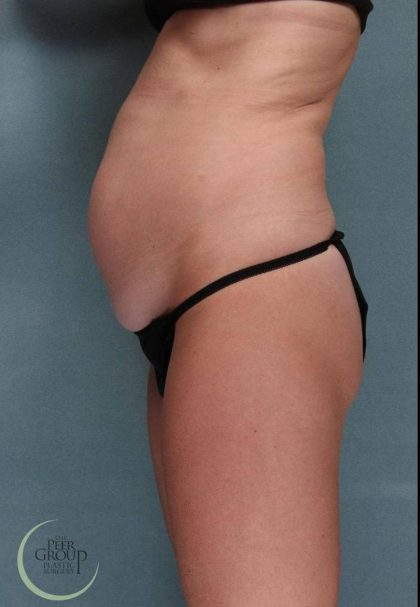 Tummy Tuck Before & After Patient #9144