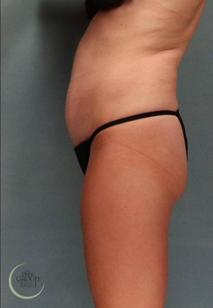 Tummy Tuck Before & After Patient #9144