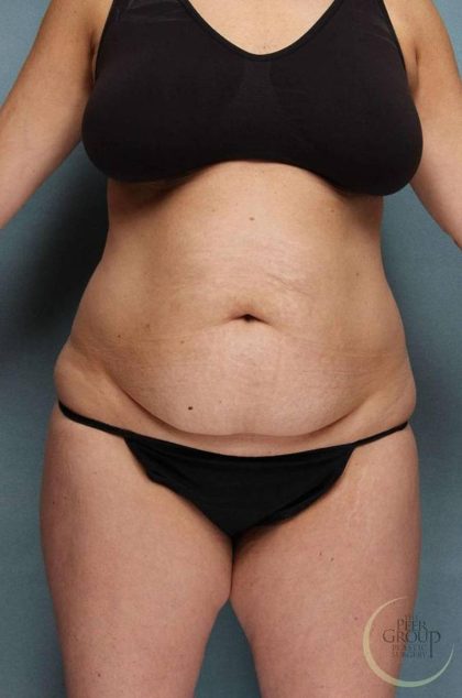 Tummy Tuck Before & After Patient #9147