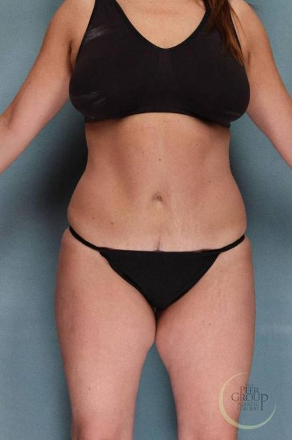 Tummy Tuck Before & After Patient #9147