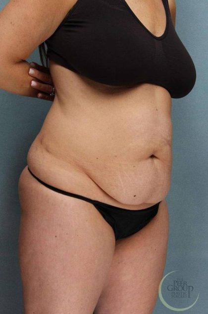 Tummy Tuck Before & After Patient #9147