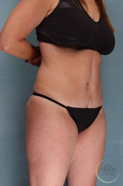 Tummy Tuck Before & After Patient #9147