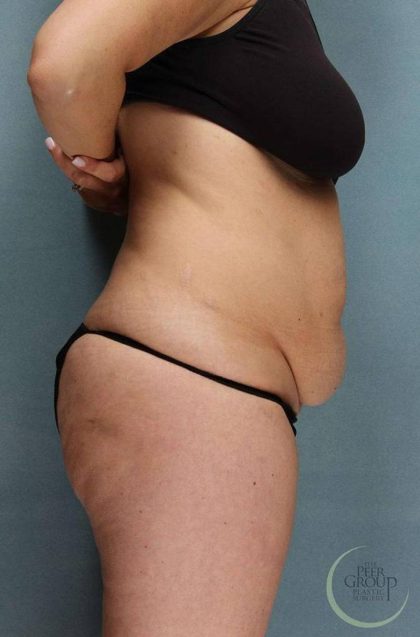 Tummy Tuck Before & After Patient #9147