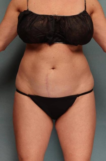 Tummy Tuck Before & After Patient #9135