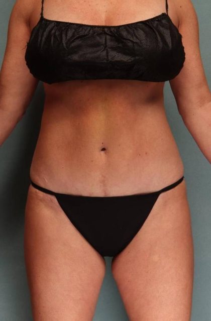 Tummy Tuck Before & After Patient #9135