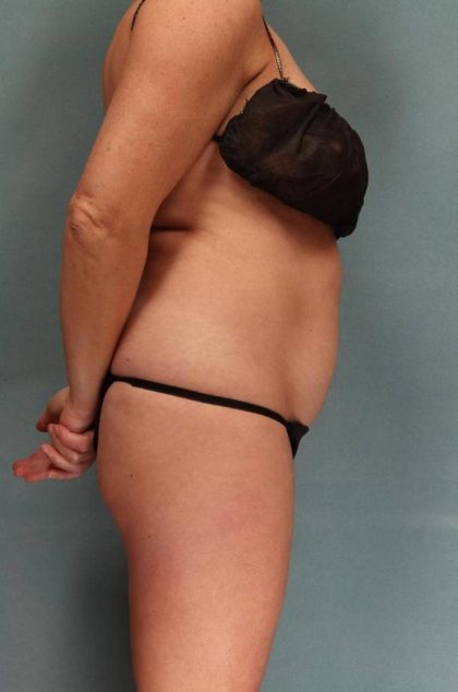 Tummy Tuck Before & After Patient #9135
