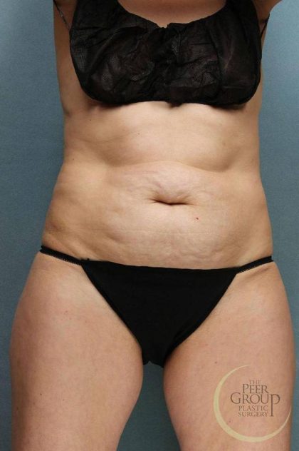 Tummy Tuck Before & After Patient #9157